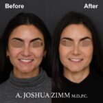 2 Rhinoplasty Before And After 43