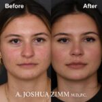 2 Rhinoplasty Before And After 44