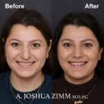2 Rhinoplasty Before And After 45