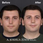 2 Rhinoplasty Before And After 47