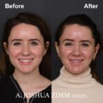 2 Rhinoplasty Before And After 49