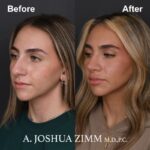 2 Rhinoplasty Before And After 5