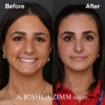 2 Rhinoplasty Before And After 51