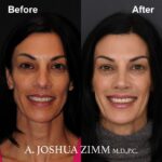 2 Rhinoplasty Before And After 52
