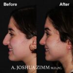 2 Rhinoplasty Before And After 54