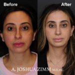 2 Rhinoplasty Before And After 56