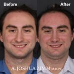 2 Rhinoplasty Before And After 57
