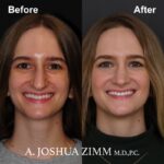 2 Rhinoplasty Before And After 58