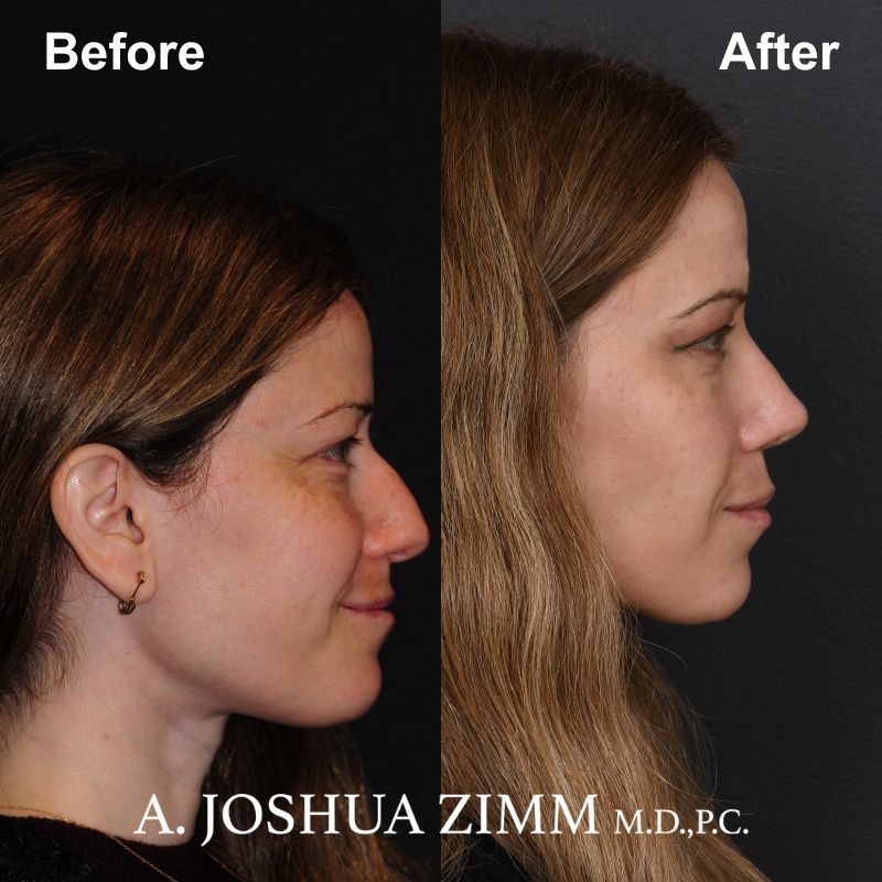 2 Rhinoplasty Before And After 59