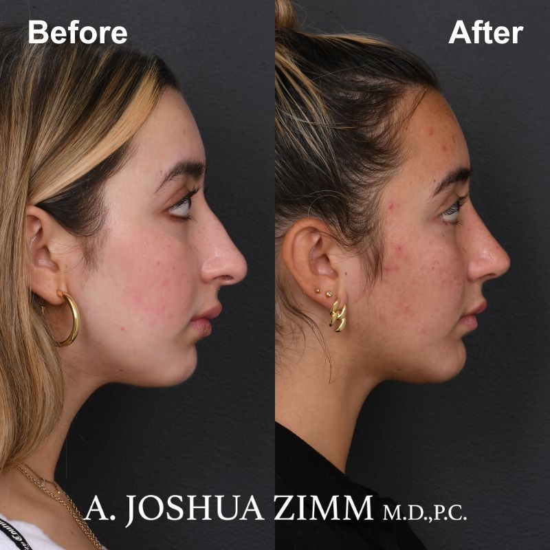 2 Rhinoplasty Before And After 61