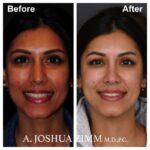 2 Rhinoplasty Before And After 62