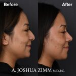 2 Rhinoplasty Before And After 7