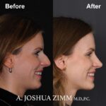 2 Rhinoplasty Before And After 8