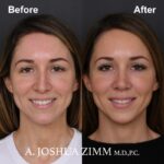 2 Rhinoplasty Before And After 9