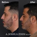 2.FaceTite AccuTite Before And After