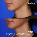 3 FaceTite AccuTite Before And Afte