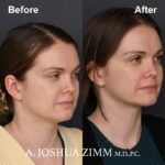 3 FaceTite AccuTite Before And After