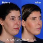 3 FaceTite AccuTite Before And After 2