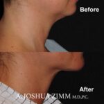 3 FaceTite AccuTite Before And After 3