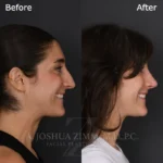 3 Months Post OSR