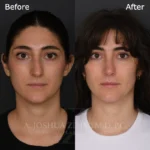 3 Months Post OSR FPNS