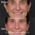 3 Otoplasty Before And After