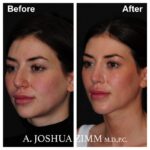3 Chin Implant Before And After