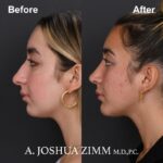 3 Chin Implant Before And After 2