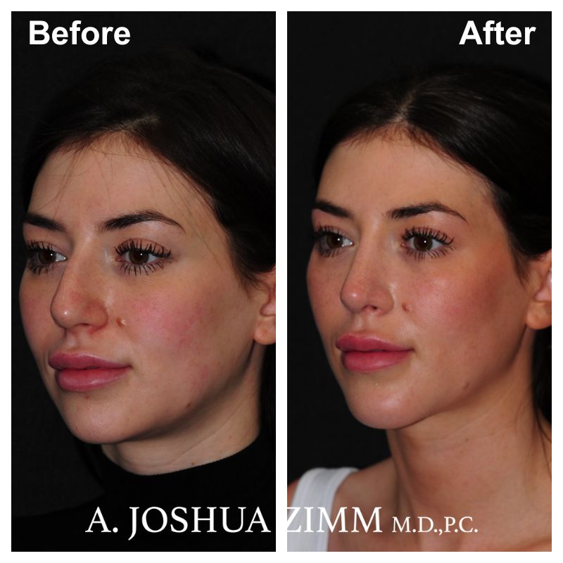 3 Chin Implant Before And After