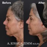 3 Facelift Before And After 1 1