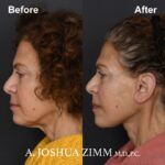 3 Facelift Before And After 2