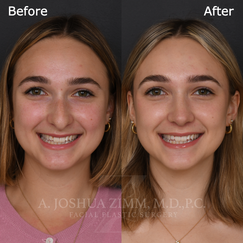 3 Months FPS 1