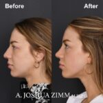 3 Revision Rhinoplasty 1