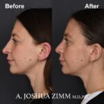 3 Revision Rhinoplasty 3