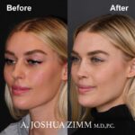 3 Rhinoplasty Before And After 1 1