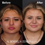 3 Rhinoplasty Before And After 1