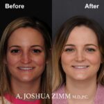 3 Rhinoplasty Before And After 10