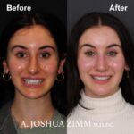3 Rhinoplasty Before And After 15