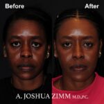 3 Rhinoplasty Before And After 17