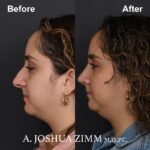 3 Rhinoplasty Before And After 18