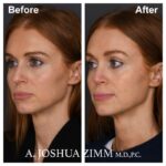 3 Rhinoplasty Before And After 20