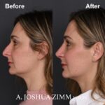 3 Rhinoplasty Before And After 22