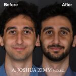 3 Rhinoplasty Before And After 24