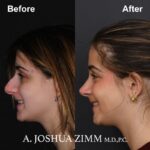 3 Rhinoplasty Before And After 25