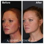 3 Rhinoplasty Before And After 27