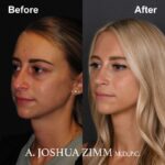 3 Rhinoplasty Before And After 28