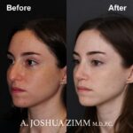 3 Rhinoplasty Before And After 29