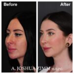 3 Rhinoplasty Before And After 30