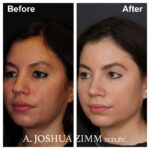 3 Rhinoplasty Before And After 33