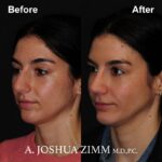 3 Rhinoplasty Before And After 34
